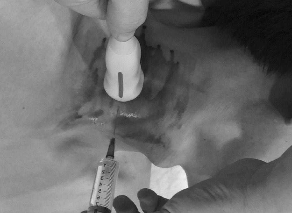 Needle is inserted almost perpendicular to skin.