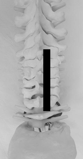 그보다약간작은제6경추극돌기가상부에서확인되고그로부터상부로올라가며제2경추극돌기까지확인할수있 Proximal Distal Figure 3. Surface anatomy of the lateral neck region. elow mastoid process (M), articular pillars (white arrows) can be palpated.