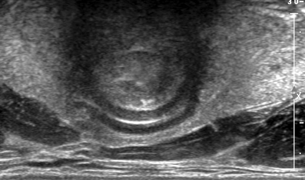 () Ultrasonography on longitudinal scan at midline of the anterior cervical area shows