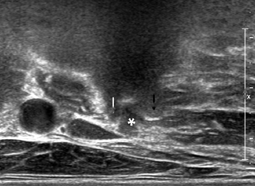 81 Ultrasound-Guided Intervention in ervical Spine IJV Figure 8. () xial transverse image showing sharp anterior tubercle (white arrow) and posterior tubercle (black arrow) of 6 transverse process.