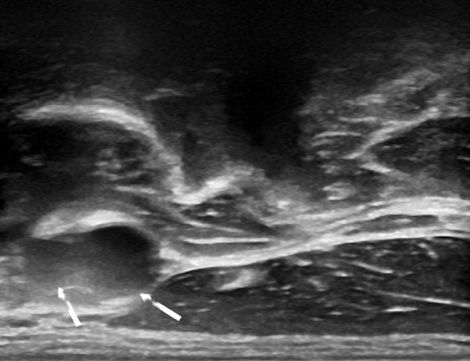 () 4 transverse process (4 Tr) can be shown at the level of carotid artery bifurcation