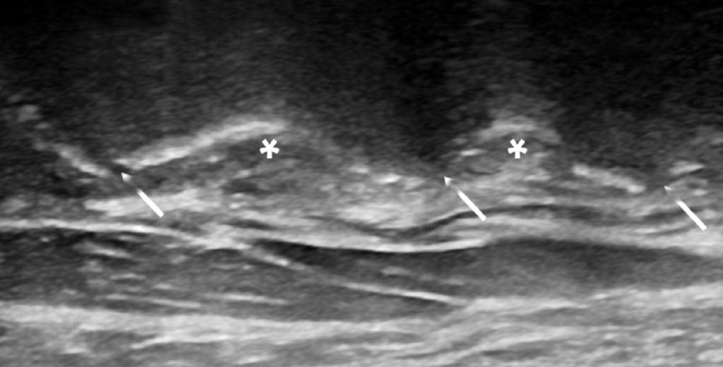 85 Ultrasound-Guided Intervention in ervical Spine Proximal Distal Figure 17.