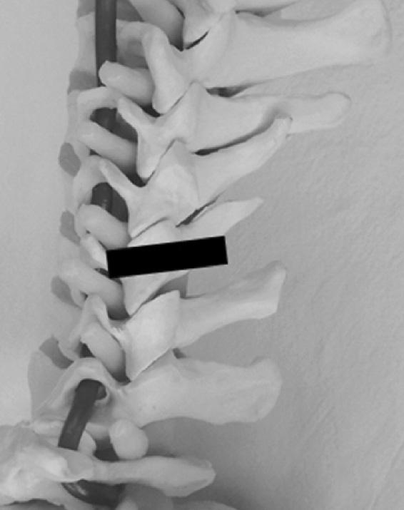 pillars on which medial branches run (asterisk).