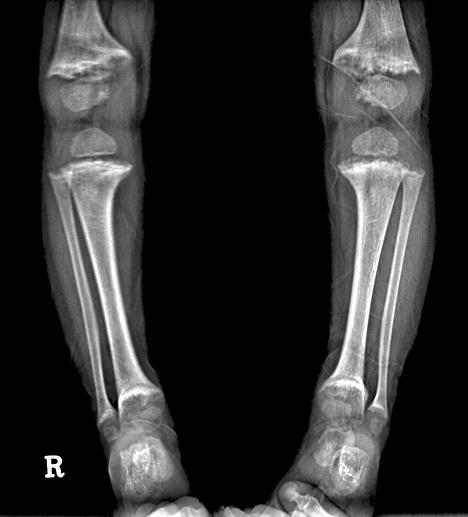 irregularity of metaphyseal border; undermineralization. Fig. 2. Radiographs of a rickets patient after treatment. calciferol이 17.