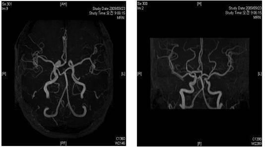 272 Chul-Seung Kim. Factors Analysis Affecting Treatment of Posterior Canal Benign Paroxysmal Positional Vertigo Figure 5. BA abnormality in MRA.