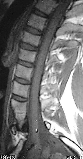 HD Jang, et al. 결 Table 1. Clinical features of 15 cases with syringomyelia 과 Interval to Sx(mo) Extent of syrinx L2 Fx 60 C7-T10 Hypesthesia and weakness of Rt. L/Ext. 69/M T23 Fx 366 C7-T3 Rt.