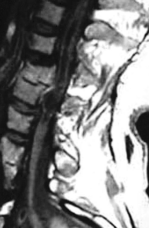 C5 burst fracture. APreoperative MR image showing cervicothoracic syrinx.