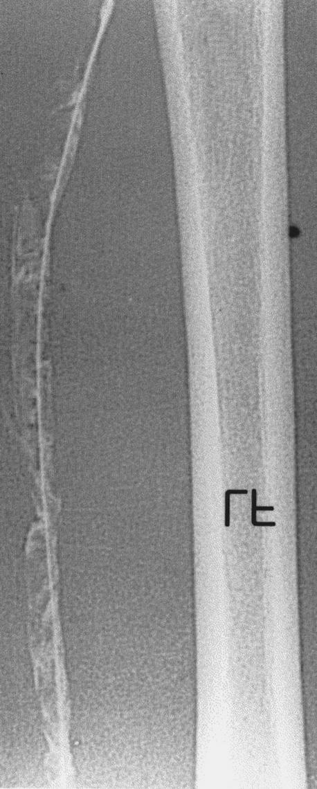 IVC inferior vena cava, RF right femur, LF left