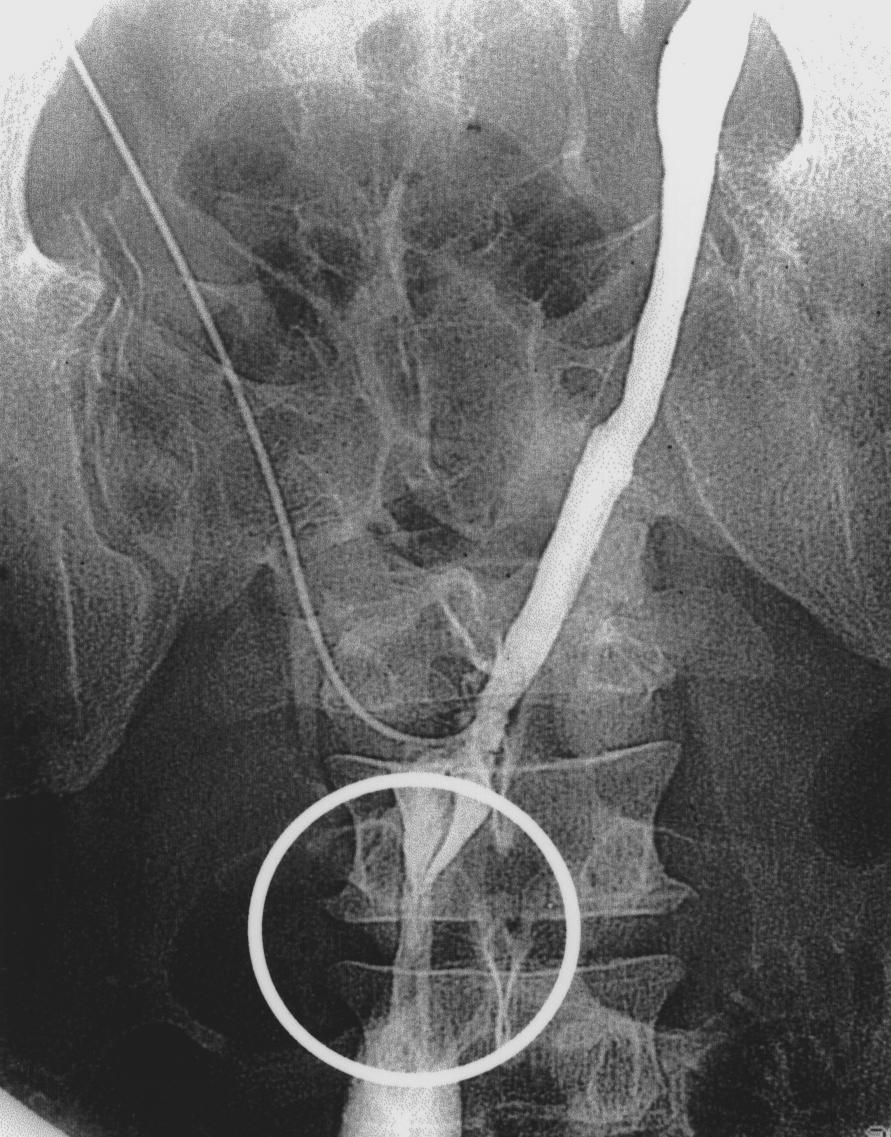 multiple filling defects within both iliac and
