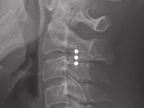 또한감염이국 소적진행하면경막상농양을형성할수있고또전신적으 로전파되면패혈증이생길수있다. 신경근근처에출혈 A Figure 4. Lumbar transforaminal epidural block. (A) Anterior-posterior (AP) view.