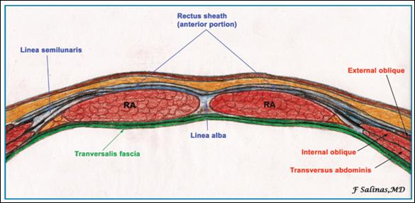 1) 피부와 layer of subcutaneous tissue와 adipose tissue 2) anterior rectus sheath 3) rectus muscle 4) posterior rectus sheath 5) inferior