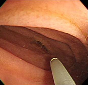 In axial and coronal view, the aorto-mesenteric distance is 5 mm approximately. Figure 4. Fluoroscopic finding.