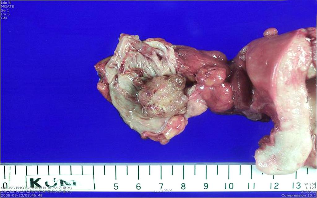 (B) Right fallopian tube reveal whitish fiable solid mass (1.8 1.8 1.8 cm) in lumen. A B C D Fig. 5.