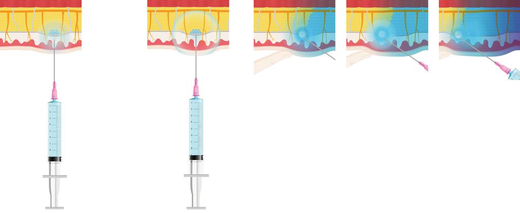 Sang-Woo Kang, et al. Wide-Awake Surgery 1. Before 26 min 2. 27 gauge needle 3. Room-temperature local anesthetic 4. Lidocaine: 8.4% sodium bicarbonate=(10:1) 1cm 1cm 1cm Wait 15-45 sec Fig. 2. Illustration for the reduction of injection-associated pain.