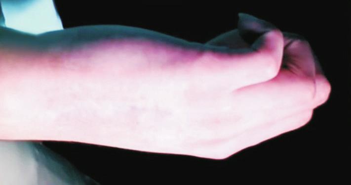 Archives of Hand and Microsurgery Vol. 23, No.
