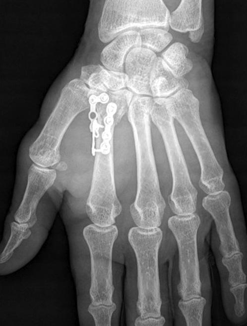 open metacarpal