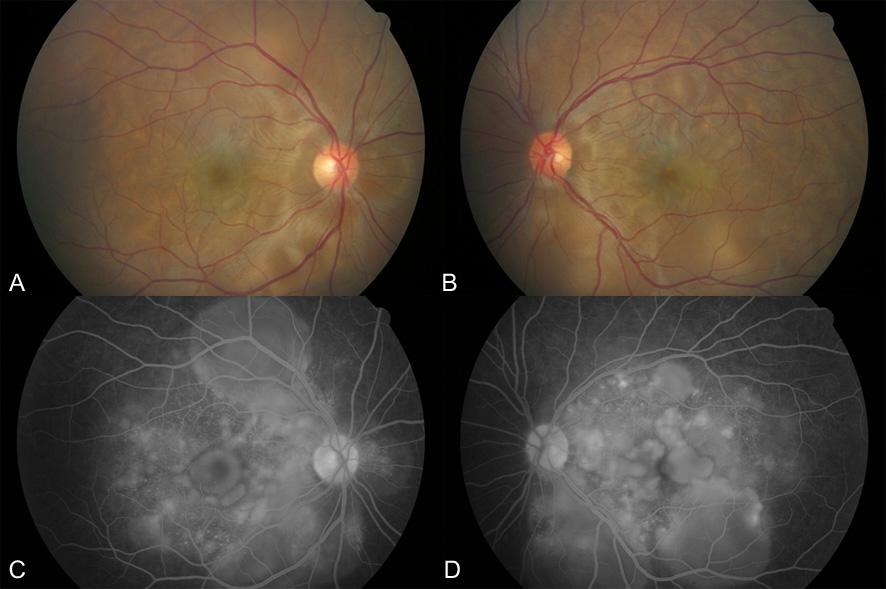 대한안과학회지제 49 권제 7 호 2008 년 Figure 1. Fundus photographs of the right eye (A) and left eye (B) showing multifocal serous retinal detachment in both eyes.
