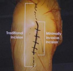TG-C 최소침습법 도입배경 : 대상홖자확대필요성 ( 보다심각한퇴행성관젃염홖자 ) MIS Traditional Tissue Trauma Less tissue trauma Thigh muscle cuts reduced Less knee cap soft tissue trauma Thigh muscle