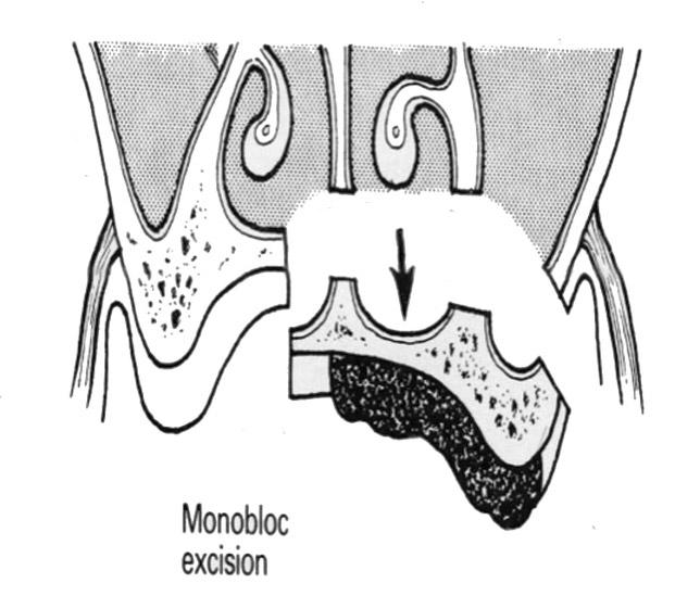Fig. 7. Schematic view of monobloc excision. Fig. 8. Schematic view of excision by layers. 을용이하게보존할수있었다 20.(Fig. 8) 수술후방사선검사에서상악동의점막비후가나타나기는하였으나, 상악동의기능은수술전과다르게보이지않았다.(Fig. 9) 현재환자는수술후경과관찰중이며, 10 개월이지난지금까지재발양상은발견할수없었고, 수술부위의치유양상은매우양호한편이다.