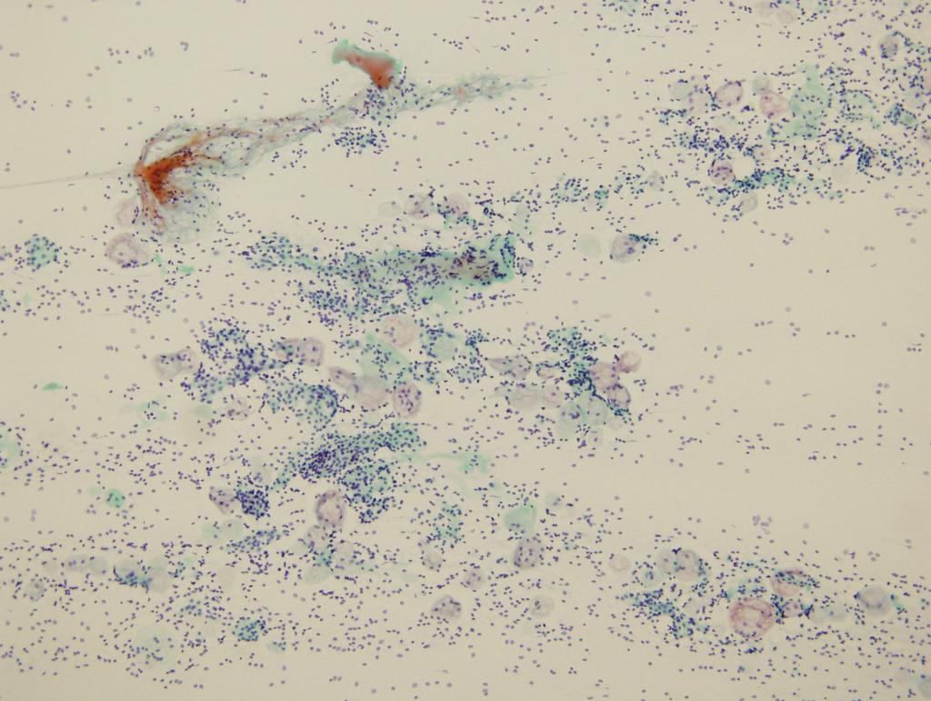이혜경 외 : 귀밑샘의 상피-근육상피암종의 세포 소견 Fig. 1. Fine needle aspiration cytology of case 1.