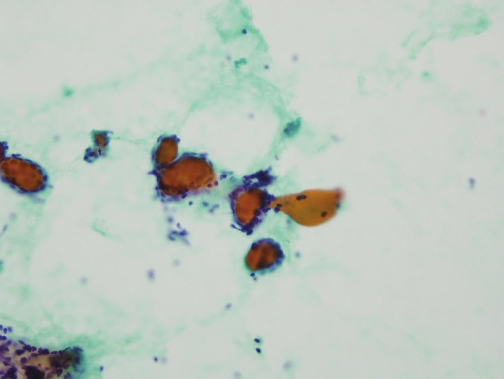 HK Lee et al. : FNAC of Epithelial-Myoepithelial Carcinoma of Parotid Gland Fig. 5. Fine needle aspiration cytology of case 2.