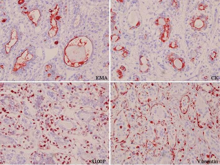 이혜경외 : 귀밑샘의상피 - 근육상피암종의세포소견 Fig. 7. Immunohistochemical stain of case 1.