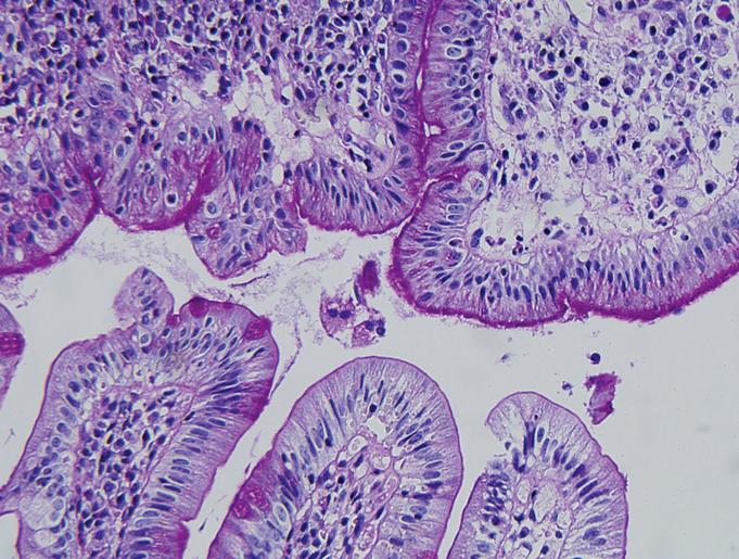 (C) It shows gastric metaplasia containing apical neutral mucin is colonized by Helicobacter pylori (Immunohistochemical stain, 400). Table 2.