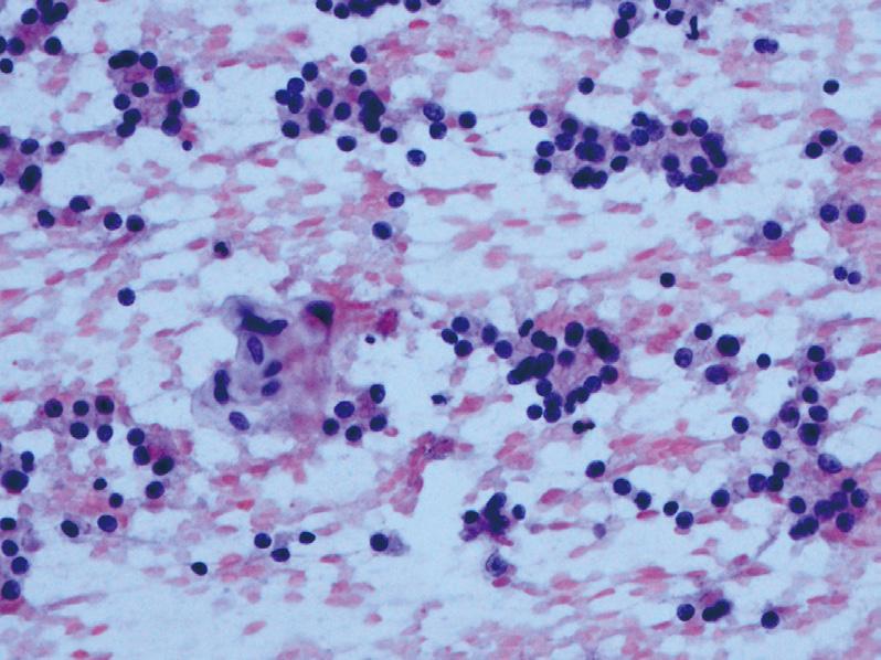 보이는 세포 관찰 (B) 악성 의심: 대부분의 세포에서 커진 핵과 핵고랑을 보이지만 핵 내 봉입체는 드물게 관찰 (C) 악성: 유두암종(papillary carcinoma)을