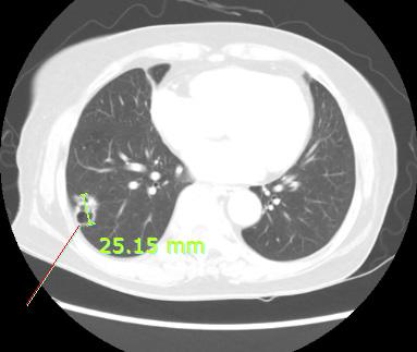 점액성선암종으로폐의쐐기절제술을시행한환자에대한한방치료 1 례 Fig. 1. The image of chest CT. Fig. 2. Before operation. about 1.8 cm sized cavitary nodule at right lower lung zone. 10.