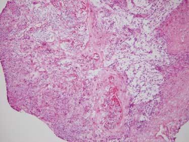 The permanent section shows pseudoepithelial hyperplasia of