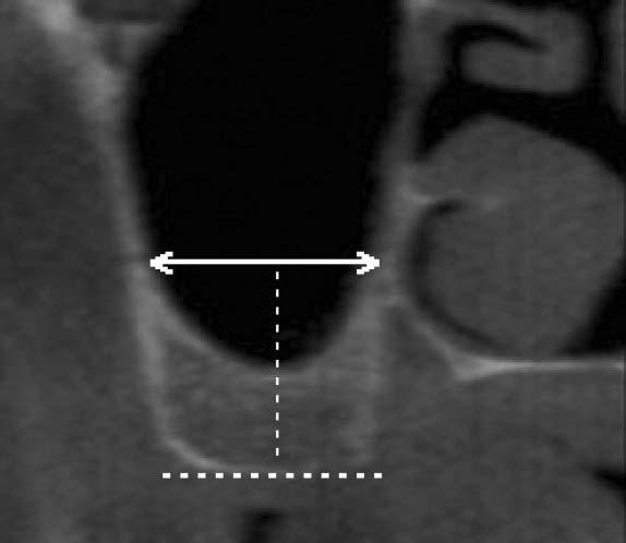 3 Shape of maxillary sinus floor: Left. smooth, Right. scalloped. 파노라마방사선사진에서측정한상악제1대구치상실부위에서의잔존치조골높이는평균 5.83mm로나타났다.