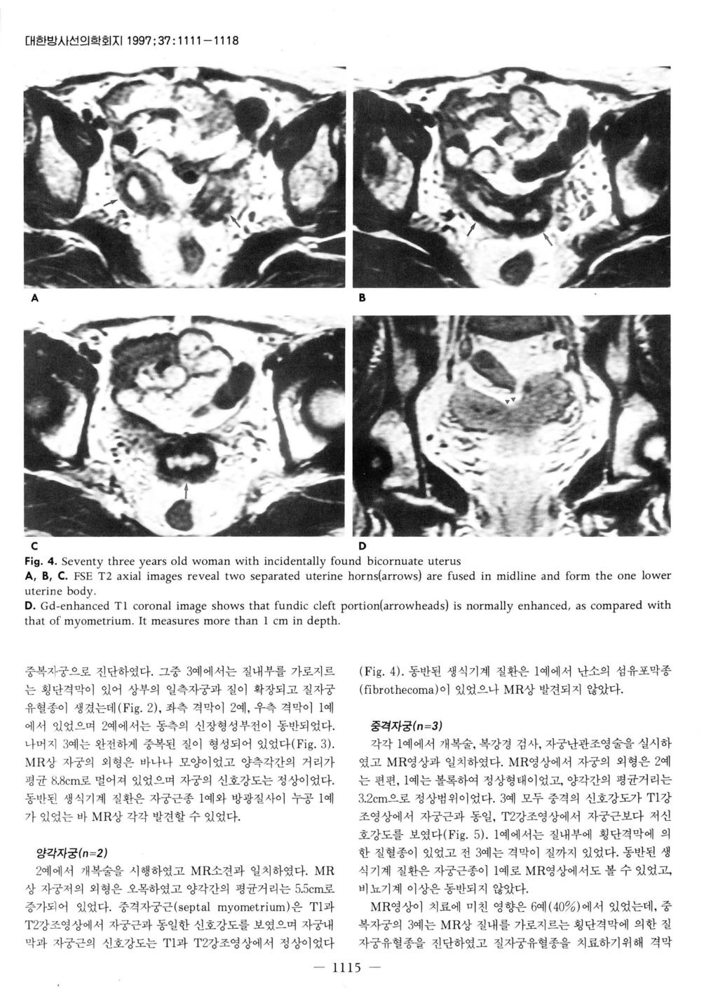 대한빙사선의학회 XI 1997; 37: 1111-1118 A B C Fig. 4. Seventy three years old woman with incidentally found bicornuate uterus A, B, C.