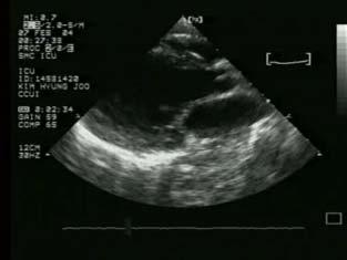 Echocardiography Date Hosp day LVID s/d (mm) EF(%) Other findings Feb. 06 1 pm Feb. 07 6 pm Feb.