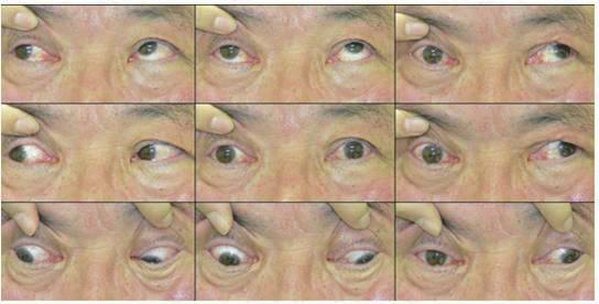 눈운동신경마비 최재환 Ventral 지부분을지배한다. 동공과조절반사를담당하는절전 (preganglionic) 부교감신경섬유는모양체신경절에서시냅스를형성한후단모양 체신경 ( 절후섬유 ) 이되어동공조임근과모양체근을지배한다. 2. 임상양상 눈돌림신경이완전히마비되면눈은외하방으로치우치고눈꺼풀 처짐 (ptosis) 이동반된다.