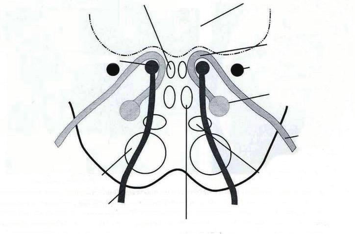 드물긴하지만중뇌출혈이나경색, 종양, 혈관기형등으로도르래신경핵이나신경섬유다발병변으로도르래신경마비가발생하기도하며, 대개는호너증후군이나감각이상, 핵간안근마비 (internuclear ophthalmoplegia), 안진등이동반된다. 대 (medial lemniscus) 를거쳐서하부교뇌의꼬리쪽경계에서나온다 (Fig. 6). 여기서외전신경은전하소뇌동맥과인접한다.