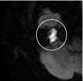 () aloric test shows 75% canal paresis on right ear. Fig.