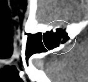 6 Postoperative brain computed tomography shows surgically removed previous mass lesion in the right petrous bone. Fig.