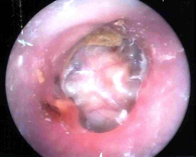 김동현외 3 인. 만성중이염과관련된화골성내이염 Fig. 1. Photographs of case 1. (A) Otoscopic examination revealed an adhesive tympanic membrane. There was no middle ear space.