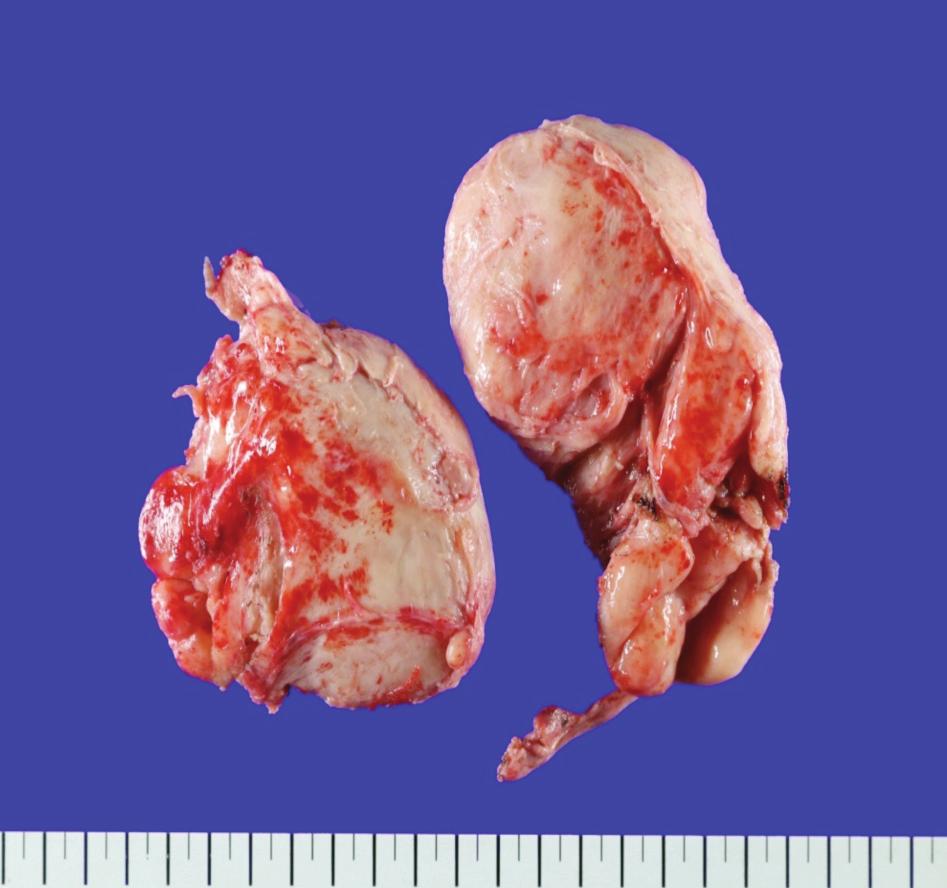 oth ureteral orifices were not identified due to the protruded huge
