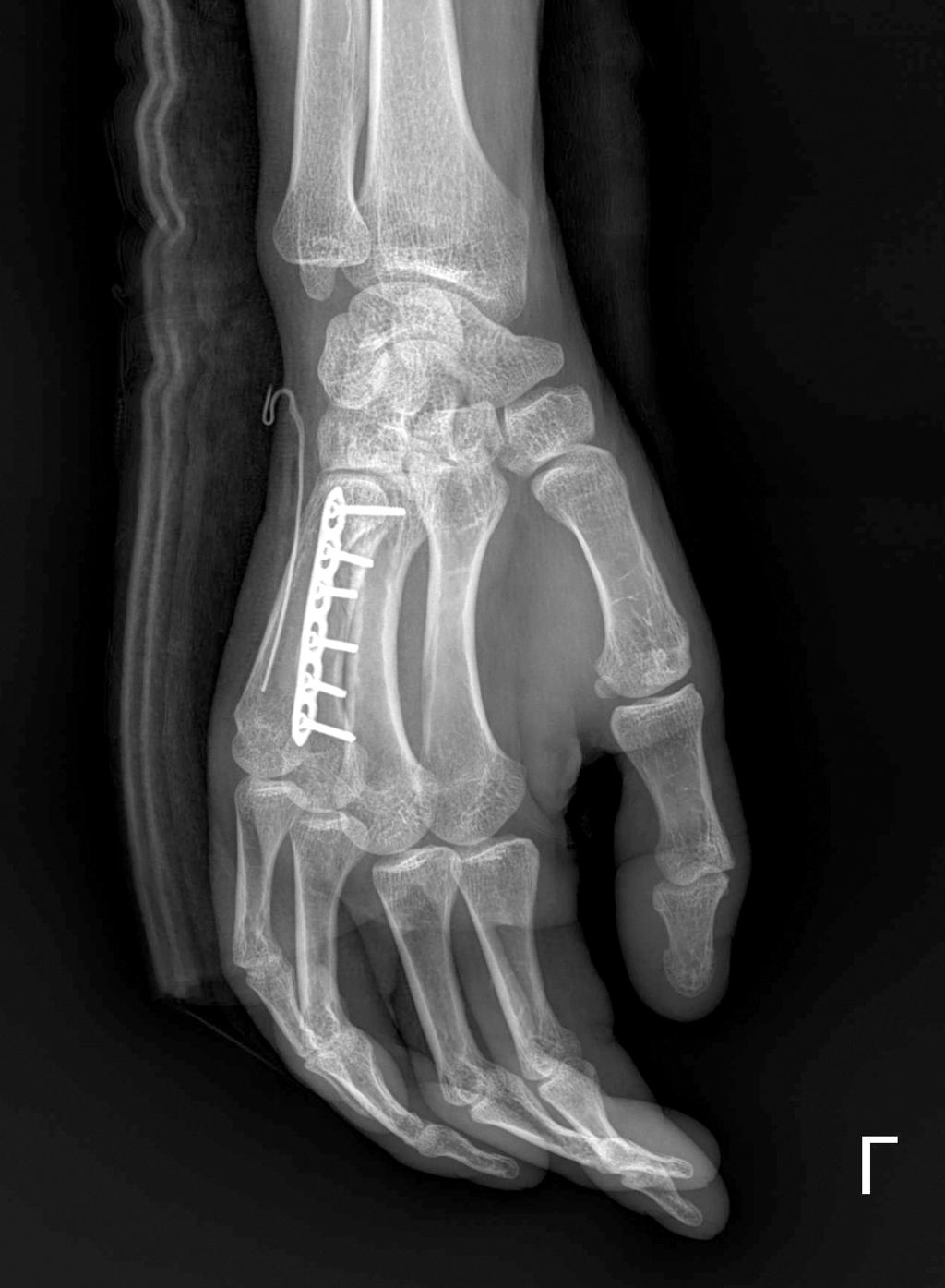 (A) A 35-yearold man had a 4th metacarpal midshaft fracture due to slip down.