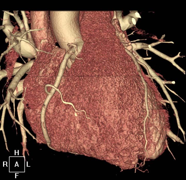 criss-cross heart Ventriculo-arterial