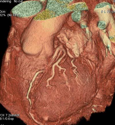 Coronary CT Angiograohy 관상동맥영상의어려움 가늘고구불구불하다 심하게움직인다 CT 는공간해상도는높으나시간해상도가낮다.
