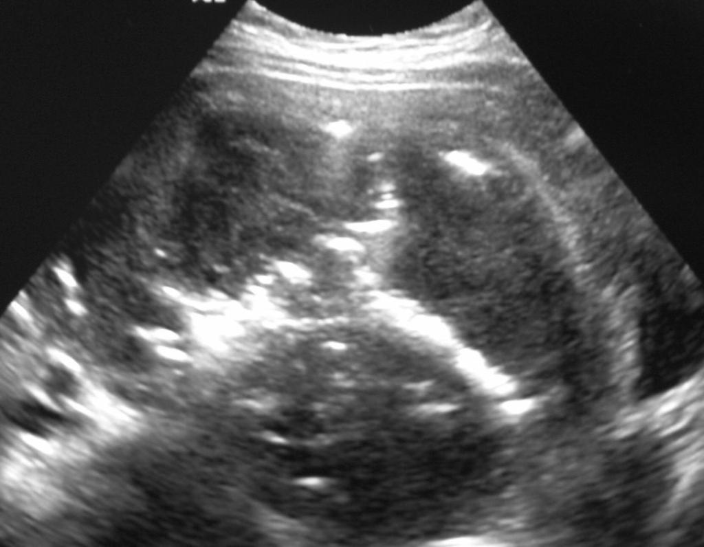 Ultrasonographic Findings after Uterine Fibroid Embolization Ultrasonographic Findings Presence of air No of Patient(%) myoma myometrium