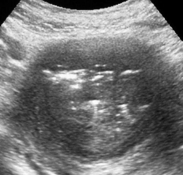 자궁강 내의 비정상적인 체액 저류는 없었다. 모든 예에서 근 B D Fig. 2. A 
