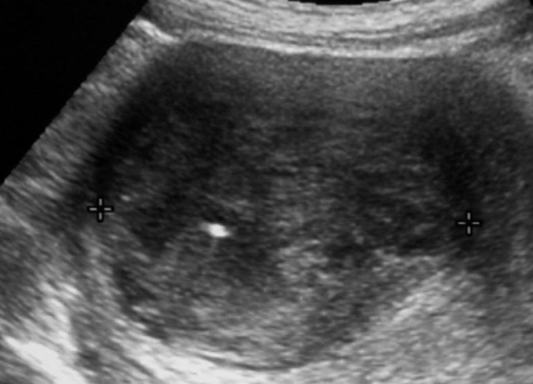 Transvaginal sonography shows a well defined hypoechoic leiomyoma in uterine body. B.