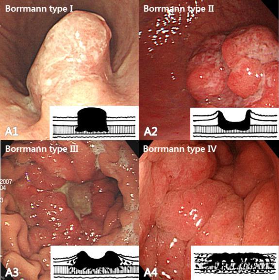 Figure 1. Borrmann s classification of advanced gastric cancer 제 I 형은융기형 (polypoid) 으로 Fig.1,A1 에서보면주변과명확하게구분되는용종성병변의 형태를띠며, 병변의점막은 불규칙하며, 비균질적인 pit pattern 을보인다.
