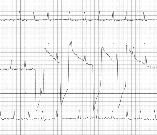 얼라이브코심전도측정기를사용하여심방세동환자의목숨을구한사례들이등장하고있음 얼라이브코심전도측정기 (AliveCor Heart Monitor) 를활용한심방세동진단사례 에릭토폴박사 ( 미 ) 는