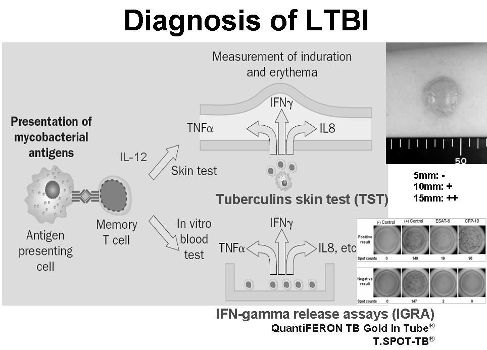 진단기준인 TST 의제한점 잠복결핵 (LTBI) 잠복결핵진단의대상자 HIV 감염자장기이식환자면역억제제장기사용자 6 세이하전염성결핵환자접촉자