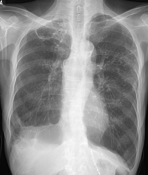 - The Korean Journal of Medicine : Vol. 74, No. 2, 2008 - Figure 1. Mycobacterium intracellulare pulmonary disease of the upper lobe cavitary form in a 72-year-old man.