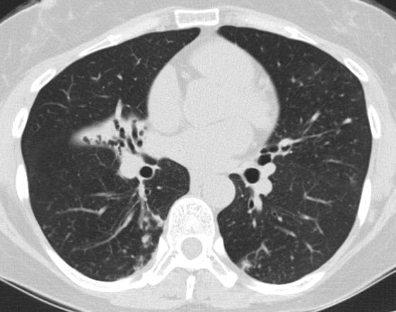 Chest radiograph shows a multifocal patchy distribution of small nodular clusters in both lower lung zones. Transaxial lung window CT images (2.